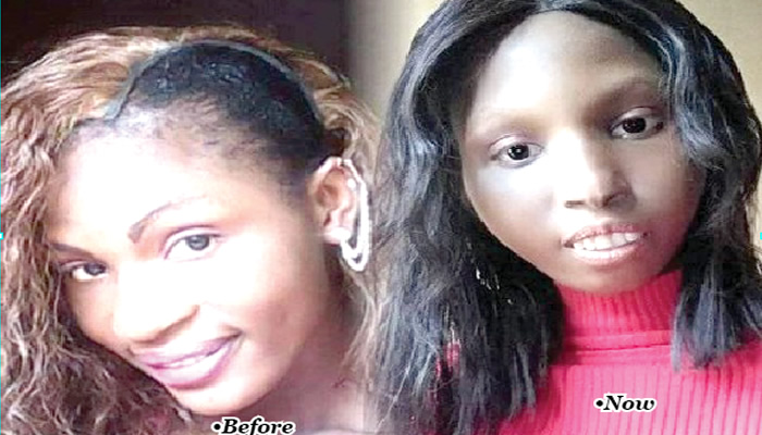 People ridicule me for my new looks – Woman with rare skin disorder